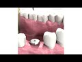 How Dentists Insert Dental Implants