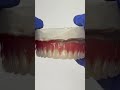 Great Process Denture #lsk121shorts #teeth #dental