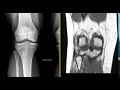 Osteochondritis Dissecans in 17 year old
