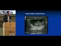 Mark Lupo - Individualized Care for Thyroid Nodules and Cancer