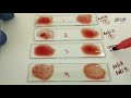 Blood grouping || reverse blood grouping method principle procedure in hindi || serum grouping