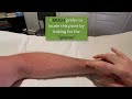 Acupuncture Point - LUNG-7 - What NOT to Do!