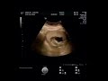Morfológica do primeiro trimestre (13 semanas e 4 dias) e sexo do bebê!