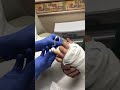 Doctor Removes Stuck Ring With Amazing Technique