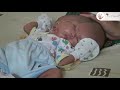 Baby With 2 Faces: Ultra Rare Conjoined Twins! 1 or 2 Personalities?  ~ Body Bizarre!