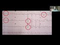 Angina Pectoris - An Approach To Chest Pain & Acute Coronary Syndrome | Stable & Unstable Angina |