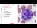 Leukocyte Abnormalities and Disorders (An overview)