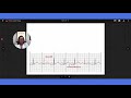 Atrioventricular Blocks (AV Blocks) - EKG Interpretation | @LevelUpRN