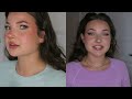 I got facial slimming botox… (before & after masseter botox, price, teeth grinding & more)