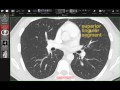 Lobar and Segmental Lung Anatomy on CT