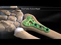 Distal Radius Fracture Repair