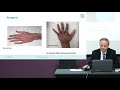 Clinical Features and Diagnostic criteria of vascular Ehlers-Danlos syndrome (vEDS)  - Part 1