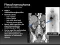 Imaging of Pheochromocytoma