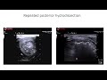 Protecting Recurrent Laryngeal Nerves in Thyroid Radiofrequency Ablation w/ Dr. Valcavi