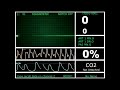 Hospital Monitor with FlatLine (L) (HD)