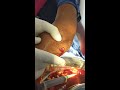 Septic arthritis, incision and drainage under LA, (Hindi)