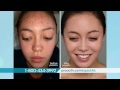 Proactiv Quick Fix Blemish Pen TV Spot