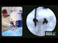 Surgical Demo: Costotransversectomy For Trauma - John E  France, M.D.