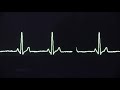 Cardiac arrest rhythms, VF, VT, Asystole and PEA
