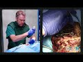 SURGICAL DEMO - Stacked Lumbopelvic Fixation - Andrew T Dailey, M.D.