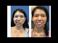 Facial Paralysis and Restoring Movement