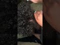 Scalp Scratching | Dandruff Removal | Big Flakes