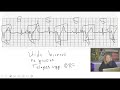 NCLEX PREP: VENTRICULAR RHYTHMS