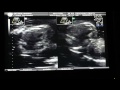 Smyres Ultrasound June 9 2014 Part 3 of 4