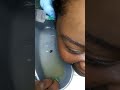 Earwax removal at the hospital