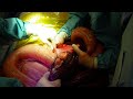 Colic surgery small intestinal lipoma 1090355