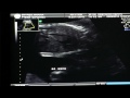 Smyres Ultrasound June 9 2014 Part 2 of 4