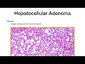 Benign Liver Tumors