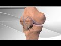 Patella Fracture Repair