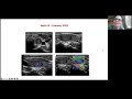 Int'l Thyroid Tumor Board w/ Dr. Mike Tuttle (Jun 2024)