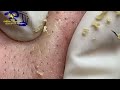 Satisfying Hien Spa Beauty Relaxing Video #28