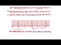 Heart Blocks Made Easy - 1st, 2nd (Mobitz 1/Wenckebach & Mobitz 2), 3rd (Complete) | with ECGs