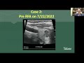 Thyroidectomy After RFA: Outcomes & Risks with Dr. Kandil
