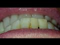 Dental Veneer Disaster  Horrible Work!