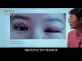 실제환자 눈재수술(퇴축교정, 소세지 제거) 후기