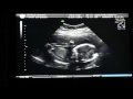 Smyres Ultrasound June 9 2014 Part 4 of 4