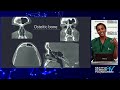 Frontal Sinus Surgical Pearls - Nithin Adappa, M.D.