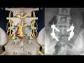 Lumbar Fusion of L5 S1 Animation