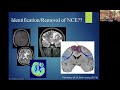 Awake Brain Tumour Surgery and Fluorescence: Towards a Standard - Dr. John Sinclair