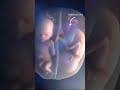 Twins Fighting in Mother's Womb #shorts