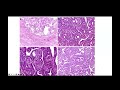 Int'l Thyroid Tumor Board w/ Dr. Mike Tuttle (Mar 2024)