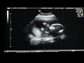 Smyres Ultrasound June 9 2014 Part 1 of 4